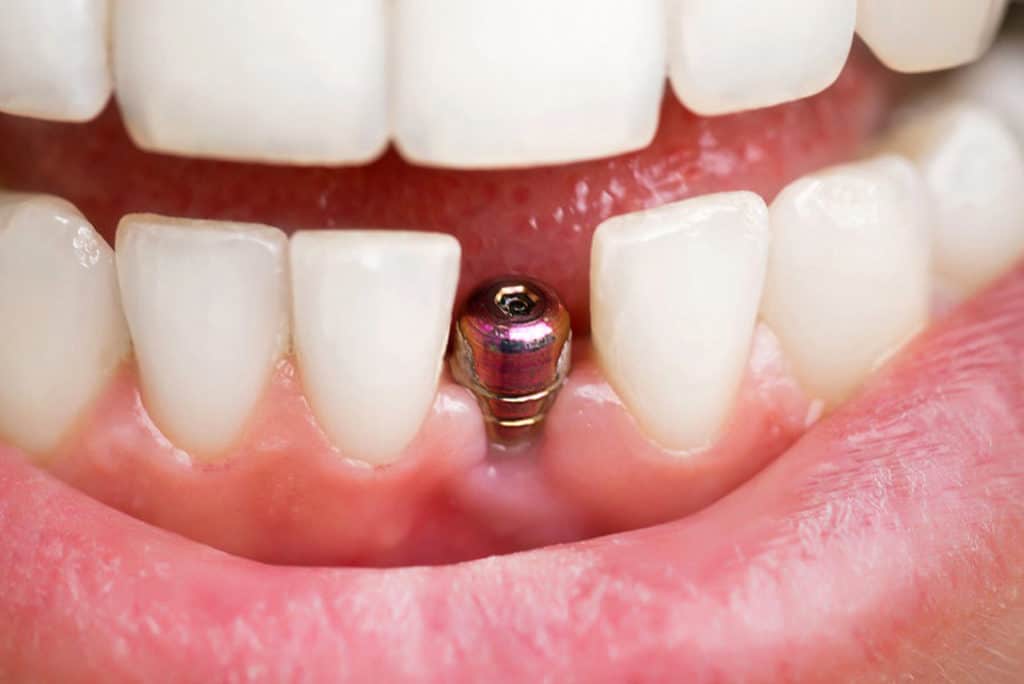 dental implants - Markham dentists by 7 Days Dental