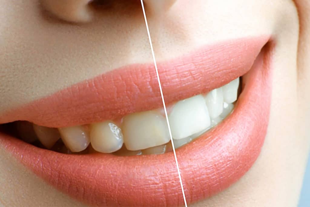 teeth whitening - Markham dentists by 7 Days Dental