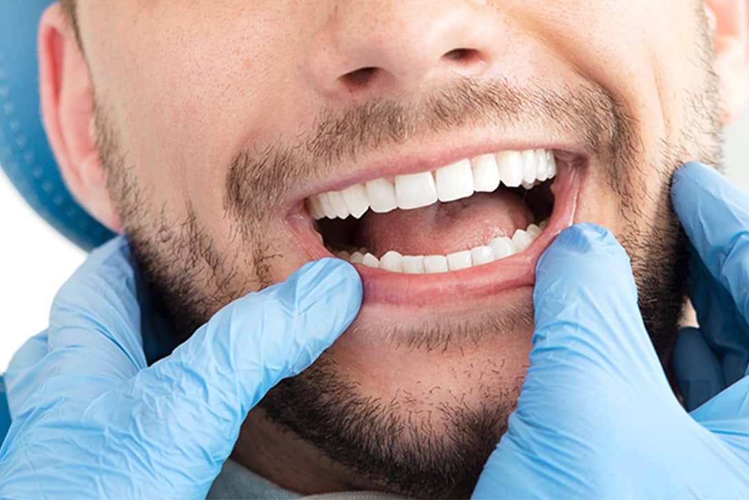dental bonding - Markham dentists by 7 Days Dental