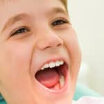 Is Getting Dental Sealants Beneficial For Your Kids?