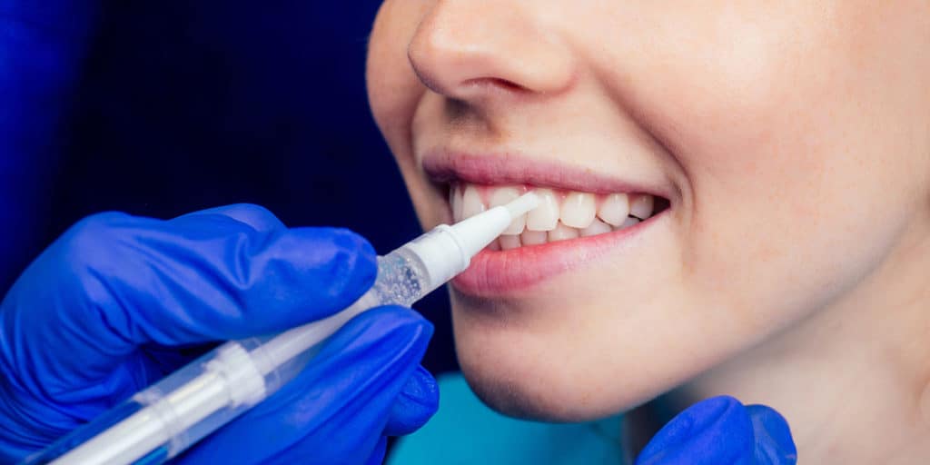 dentist applying dental sealants on patient's teeth - Markham dentists by 7 Days Dental