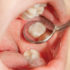 Dental Sealants In Markham:  Facts You Should Not Miss
