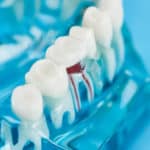 Dentist In Markham: Root Canal, Diagnosis And Therapy