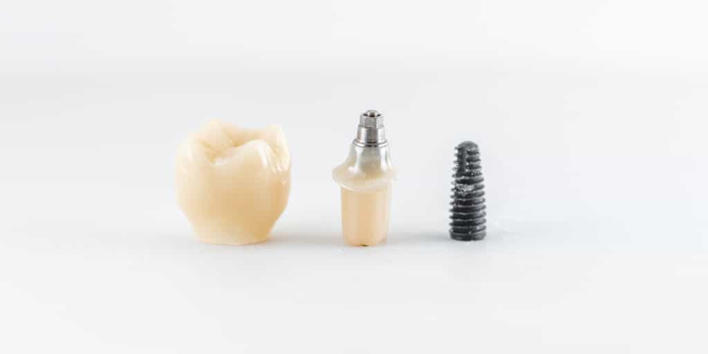 dental implants in Markham