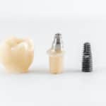 Procedure And Benefits Of Dental Implants In Markham