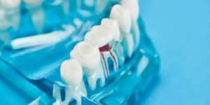 root canal treatment in markham